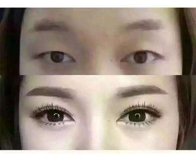 双眼皮二次修复条件及修复时间