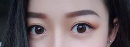 上海九院周一雄做双眼皮+开眼角真人案例_热巴同款电眼你也可以拥有