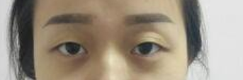 上海九院周一雄做双眼皮+开眼角真人案例_热巴同款电眼你也可以拥有