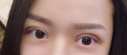上海九院周一雄做双眼皮+开眼角真人案例_热巴同款电眼你也可以拥有