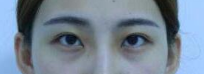 上海九院苏薇洁眼部综合整形门诊时间表_全切双眼皮+开眼角_价格表
