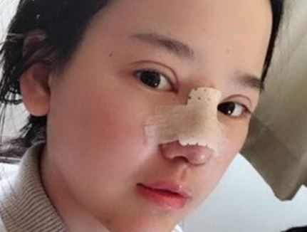 上海九院韦敏鼻综合+面部填充_门诊预约挂号_案例效果