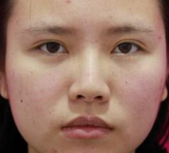 上海九院戴传昌做鼻子怎么样_真人效果案例_门诊挂号时间