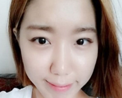 上海九院袁捷做假体隆鼻和双眼皮_效果案例_坐诊时间_预约挂号