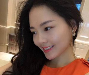 上海九院凸嘴手术_手术恢复过程图_真人案例效果_2019凸嘴整形价格
