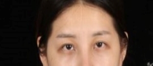 上海九院做鼻综合眼综合哪个医生好？李青峰怎么样？价格？