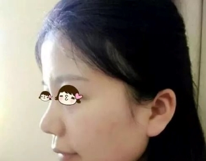 上海九院韦敏擅长做鼻子吗，做鼻子怎么样？鼻综合价格？隆鼻案例？