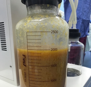 上海九院曹卫刚做吸脂效果怎么样_自体脂肪面部填充案例_恢复过程