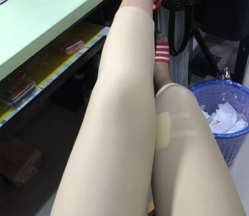 上海九院曹卫刚做吸脂效果怎么样_自体脂肪面部填充案例_恢复过程
