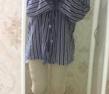 上海九院曹卫刚做吸脂效果怎么样_自体脂肪面部填充案例_恢复过程