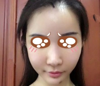 上海九院曹卫刚做吸脂效果怎么样_自体脂肪面部填充案例_恢复过程