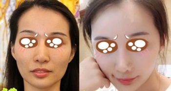 上海九院曹卫刚做吸脂效果怎么样_自体脂肪面部填充案例_恢复过程