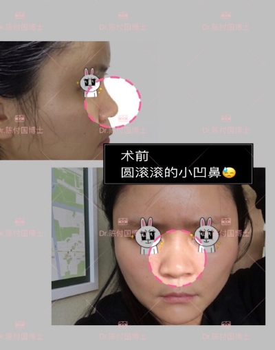 上海九院陈付国隆鼻好不好？做鼻综合怎么样？有没有案例效果图？