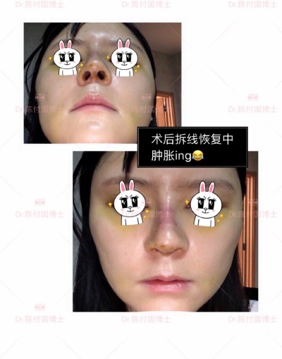 上海九院陈付国隆鼻好不好？做鼻综合怎么样？有没有案例效果图？