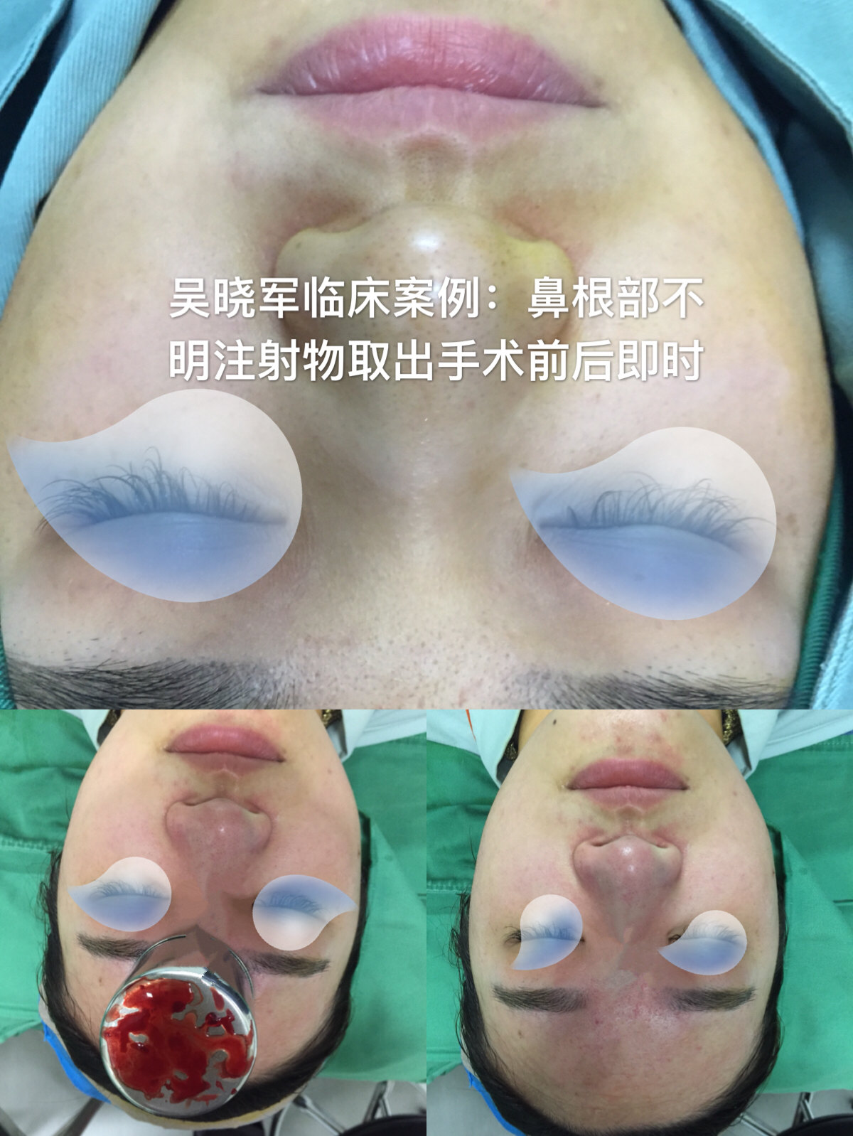 上海九院取鼻部不明注射物的专家医生哪个好？吴晓军怎么样？