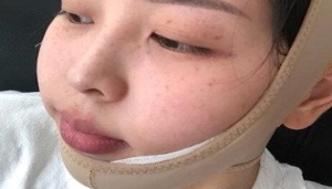 上海九院余庆雄面吸好不好_九院面部吸脂案例效果_吸脂价格