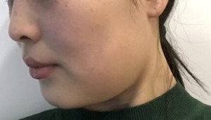 上海九院余庆雄面吸好不好_九院面部吸脂案例效果_吸脂价格