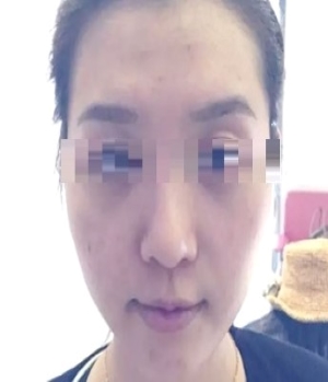 杭州维多利亚做肋骨鼻效果怎么样？做鼻子多少钱？