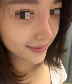 杭州维多利亚做肋骨鼻效果怎么样？做鼻子多少钱？