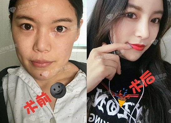 杭州格莱美张龙肋骨隆鼻怎么样？做鼻子真人案例效果？