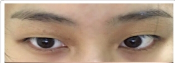 上海九院朱惠敏眼部综合整形门诊时间表_全切双眼皮+开眼角_价格表