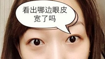 上海九院胡晓洁做双眼皮怎么样_眼综合案例效果_坐诊时间_价格