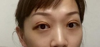 上海九院胡晓洁做双眼皮怎么样_眼综合案例效果_坐诊时间_价格