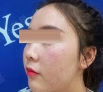 杭州艺星徐利刚做鼻子好吗？鼻修复呢？效果怎么样？