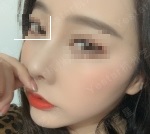 杭州艺星徐利刚做鼻子好吗？鼻修复呢？效果怎么样？
