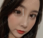 杭州艺星徐利刚做鼻子好吗？鼻修复呢？效果怎么样？