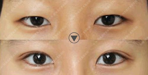 杭州时光鼻综合怎么样？正规靠谱？专家及真人案例效果图来说明