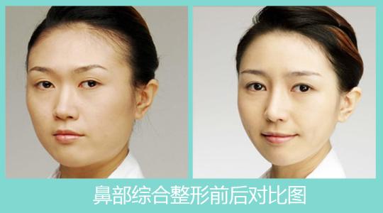 杭州时光鼻综合怎么样？正规靠谱？专家及真人案例效果图来说明