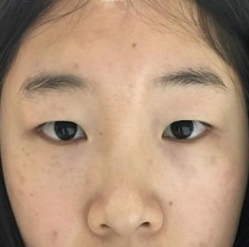 杭州时光宋茂启和吕敏相比做双眼皮哪个好？案例效果对比？