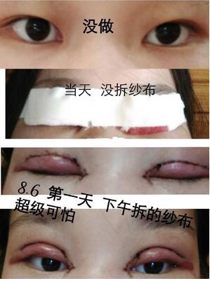 杭州时光宋茂启和吕敏相比做双眼皮哪个好？案例效果对比？