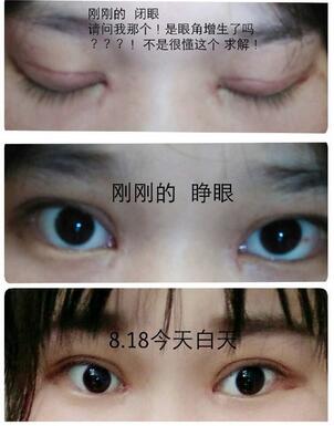 杭州时光宋茂启和吕敏相比做双眼皮哪个好？案例效果对比？