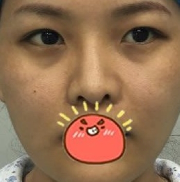 杭州格莱美汪云锋隆鼻怎么样_鼻综合+双眼皮价格_真人案例分享