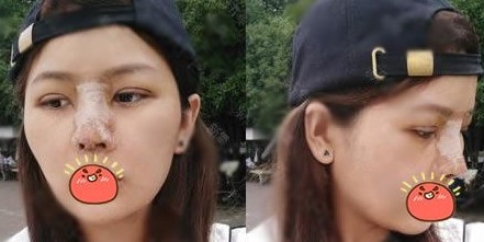 杭州格莱美汪云锋隆鼻怎么样_鼻综合+双眼皮价格_真人案例分享