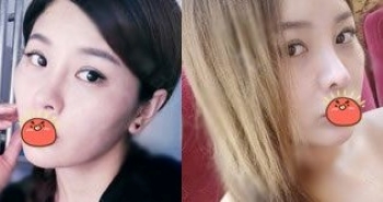 杭州格莱美汪云锋隆鼻怎么样_鼻综合+双眼皮价格_真人案例分享
