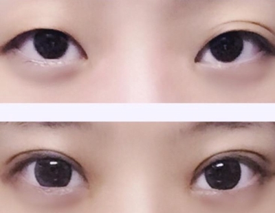 上海九院程辰双眼皮怎么样？好不好？有没有失败案例？