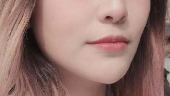 上海九院程辰怎么样_下颌缘双下巴抽脂改脸型_案例效果