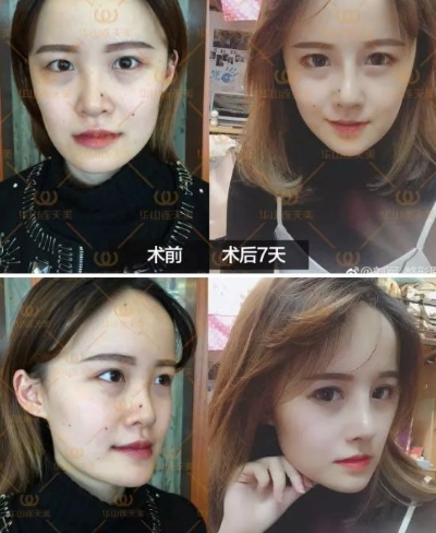 杭州华山连天美刘军做鼻子好吗?效果怎么样？鼻综合失败修复真实案例？