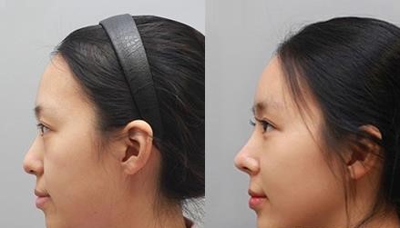 上海华美正规吗？隆鼻靠谱吗？谢卫国鼻综合案例效果？