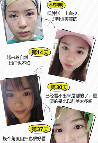 上海华美侣同帅双眼皮怎么样？和董亮，杨亚益，许再荣相比哪个医生好