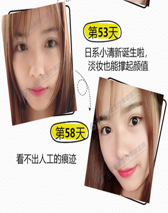 上海华美侣同帅双眼皮怎么样？和董亮，杨亚益，许再荣相比哪个医生好