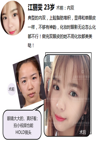 上海华美侣同帅双眼皮怎么样？和董亮，杨亚益，许再荣相比哪个医生好