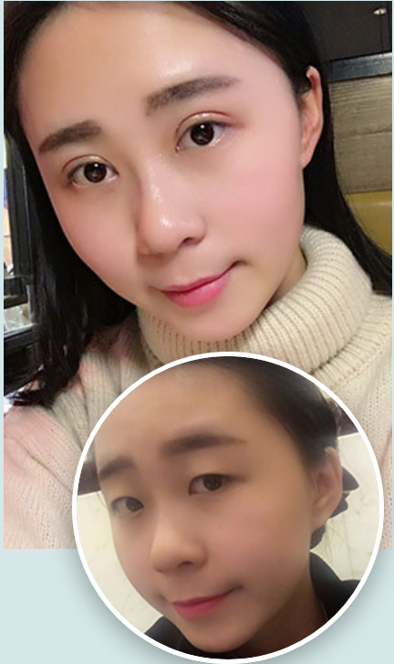 上海华美双眼皮哪个医生好？华美张朋双眼皮，开眼角怎么样？