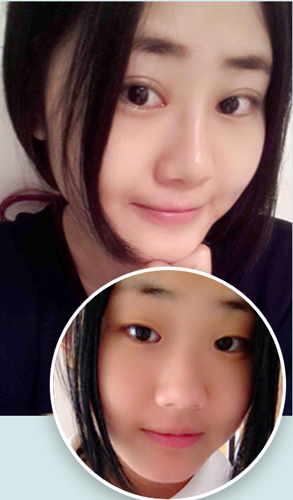 上海华美双眼皮哪个医生好？华美张朋双眼皮，开眼角怎么样？