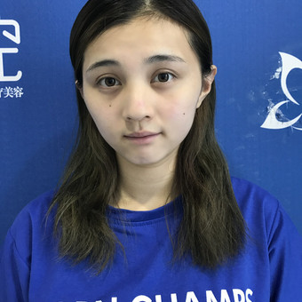 杭州颜控医疗美容赵德星_杭州颜控赵德星肋骨鼻案例_鼻综合价格
