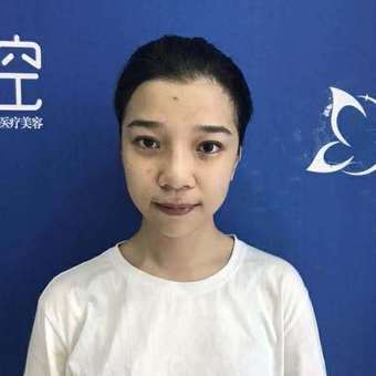 杭州颜控医疗美容赵德星_杭州颜控赵德星肋骨鼻案例_鼻综合价格