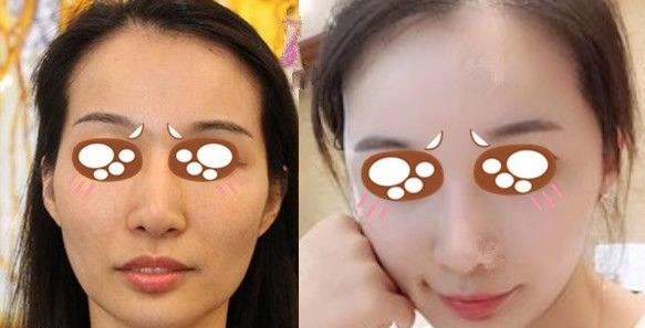上海九院脂肪填充专家医生排名_自体脂肪填充价格表_案例效果